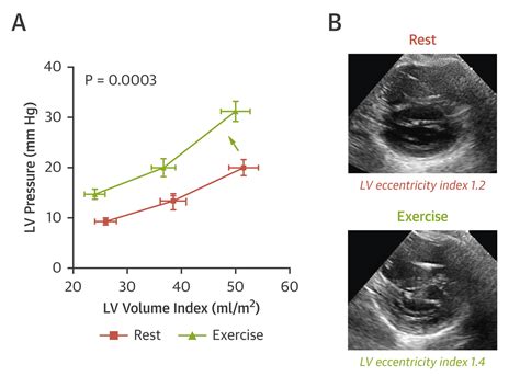 d shape lv|pericardial restraint heart failure.